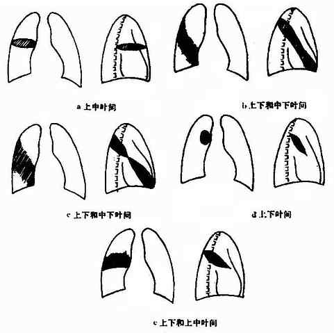 叶间积液的各种x线表现(正,侧位象)