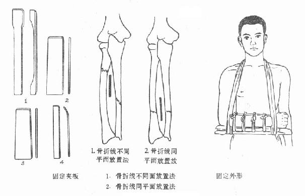 第五节尺桡骨干骨折