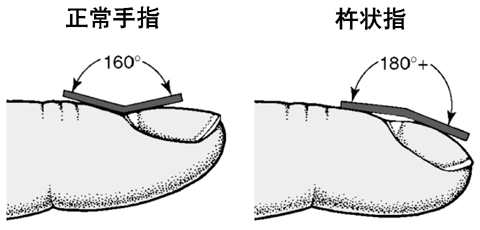 杵状指