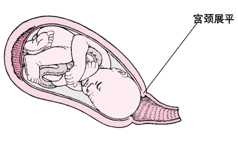 需要5小时·宫颈变薄并扩张约4cm·不舒服感觉较少·子宫收缩逐渐加强