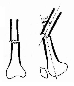 股骨下1/3横行骨折,两骨块成角40