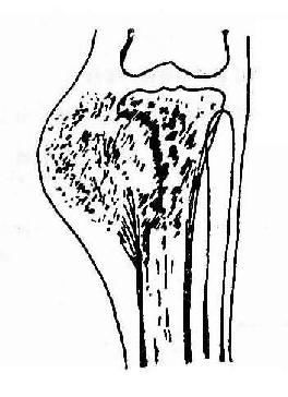 右胫骨骨软骨瘤图片图片