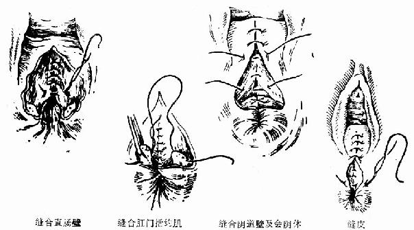 三度撕裂示意图图片