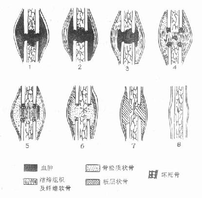 刺激骨痂生长的办法图片