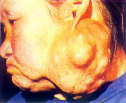 腮腺混合瘤良性图片