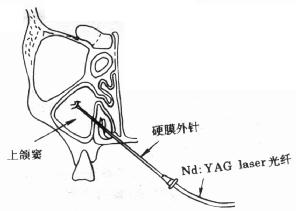 上颌窦穿刺针图片图片