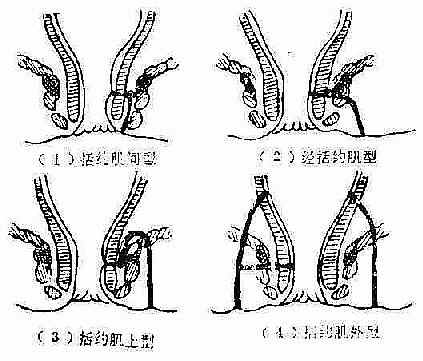 半马蹄形肛瘘图片