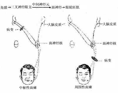 角膜反射图片