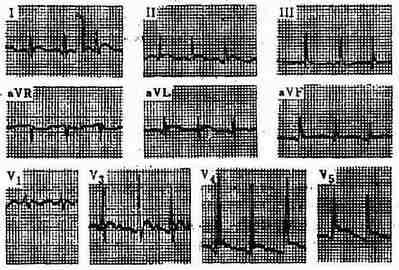 急性心包炎心电图图片