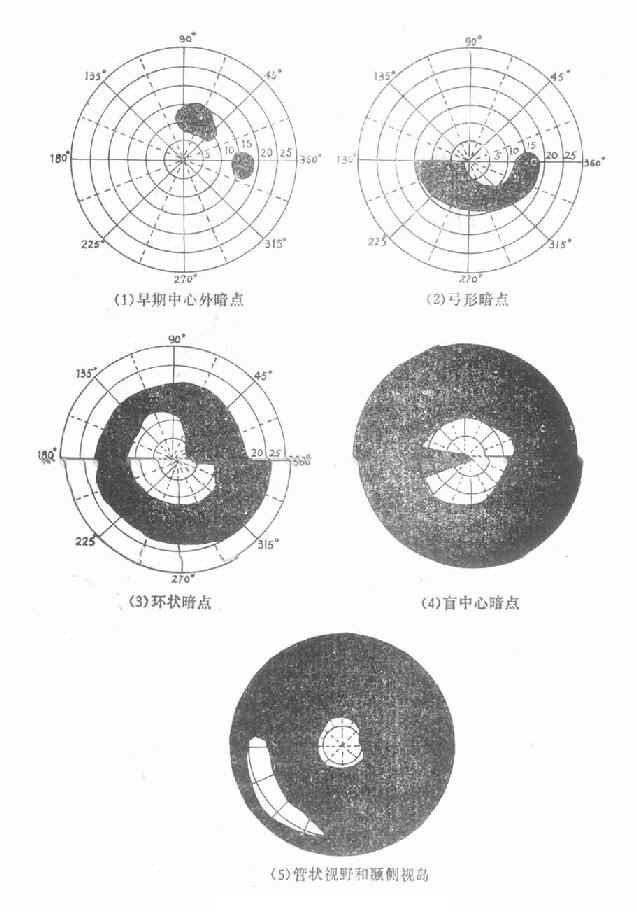 视野缺损图解图片