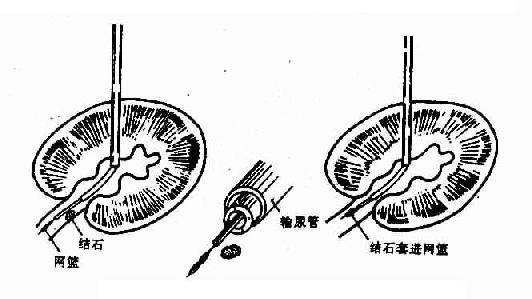 肾积水插管手术图解图片