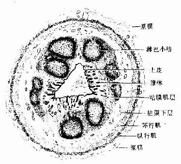 急性阑尾炎病理画图图片